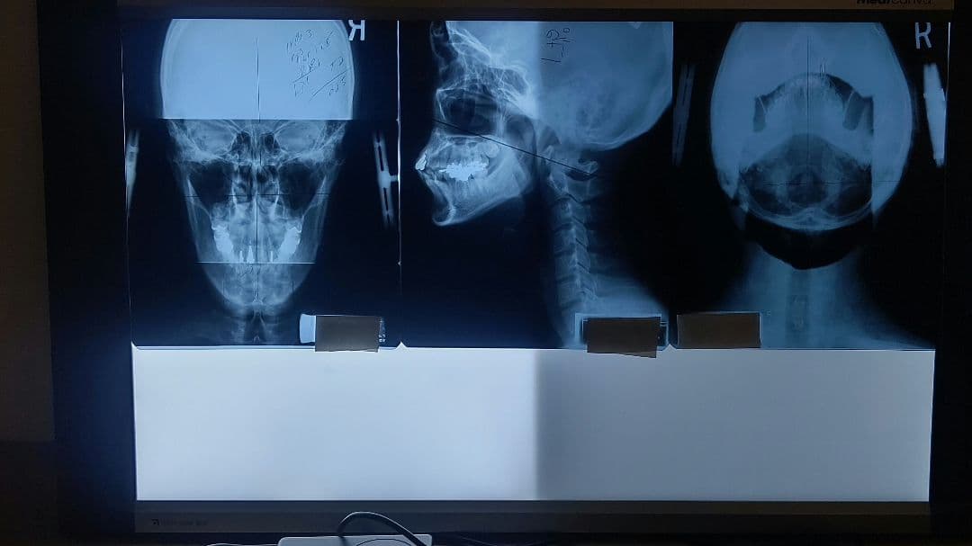 LED大型X線フィルムライトボックス